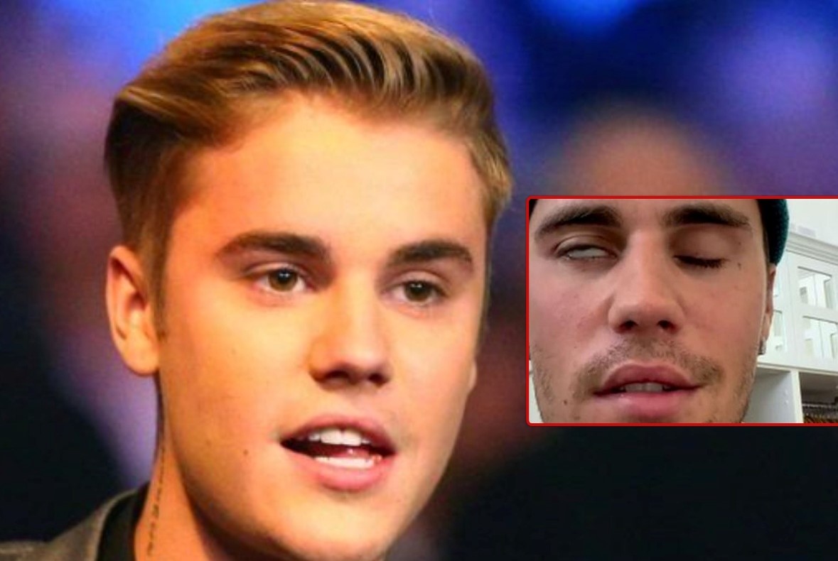 जस्टिन बिबरको अनुहारमा प्यारालाइसिस