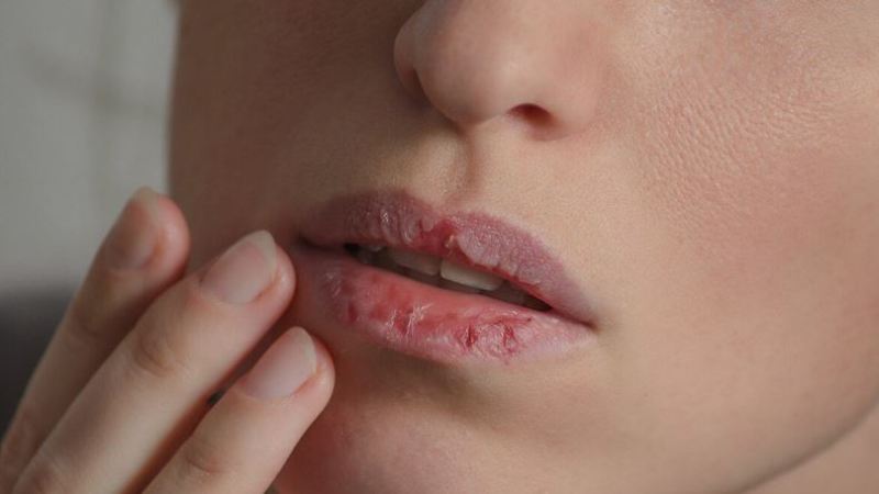 ओठ सुख्खा भएर फुटेको छ ? अपनाउनुहोस् घरेलु उपाय
