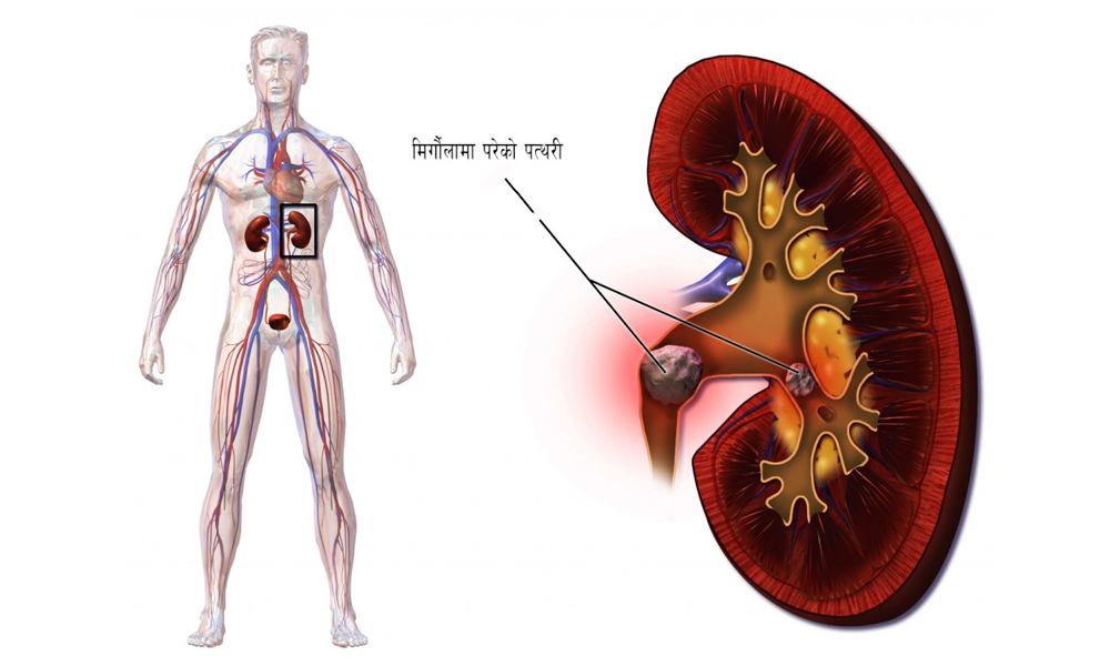 यसकारण पर्छ मिर्गौलामा पत्थरी