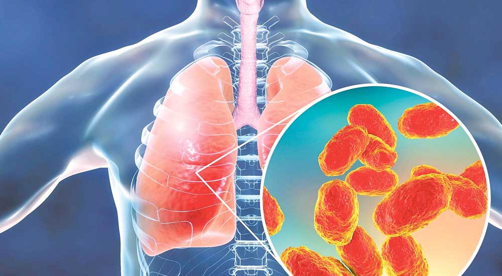 के कारणले हुन्छ निमोनिया,कसरी बच्ने ?