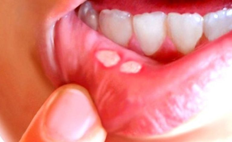 जिब्रो र मुखको खटिरा निको पार्ने घरेलु उपचार