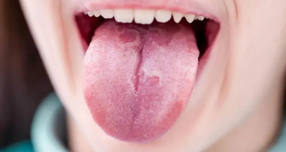 भिटामिन डीको कमी छ ? जिब्रोमा देखिन्छन् यी लक्षण