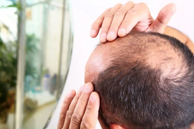 कम उमेरमै तालु खुइलियो ? हुन सक्छ ‘एलोपेसिया’