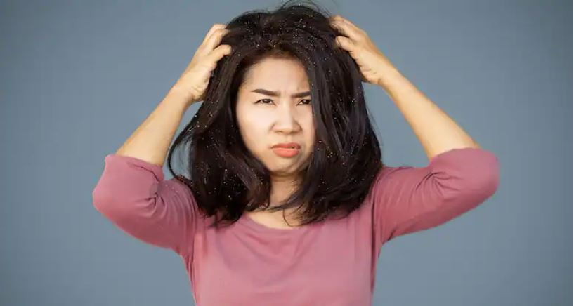 कपालको ड्रैन्ड्रफ हटाउनु छ भने दहीसँग यी समान मिसाएर घरेलु उपचार गर्नुहोस्