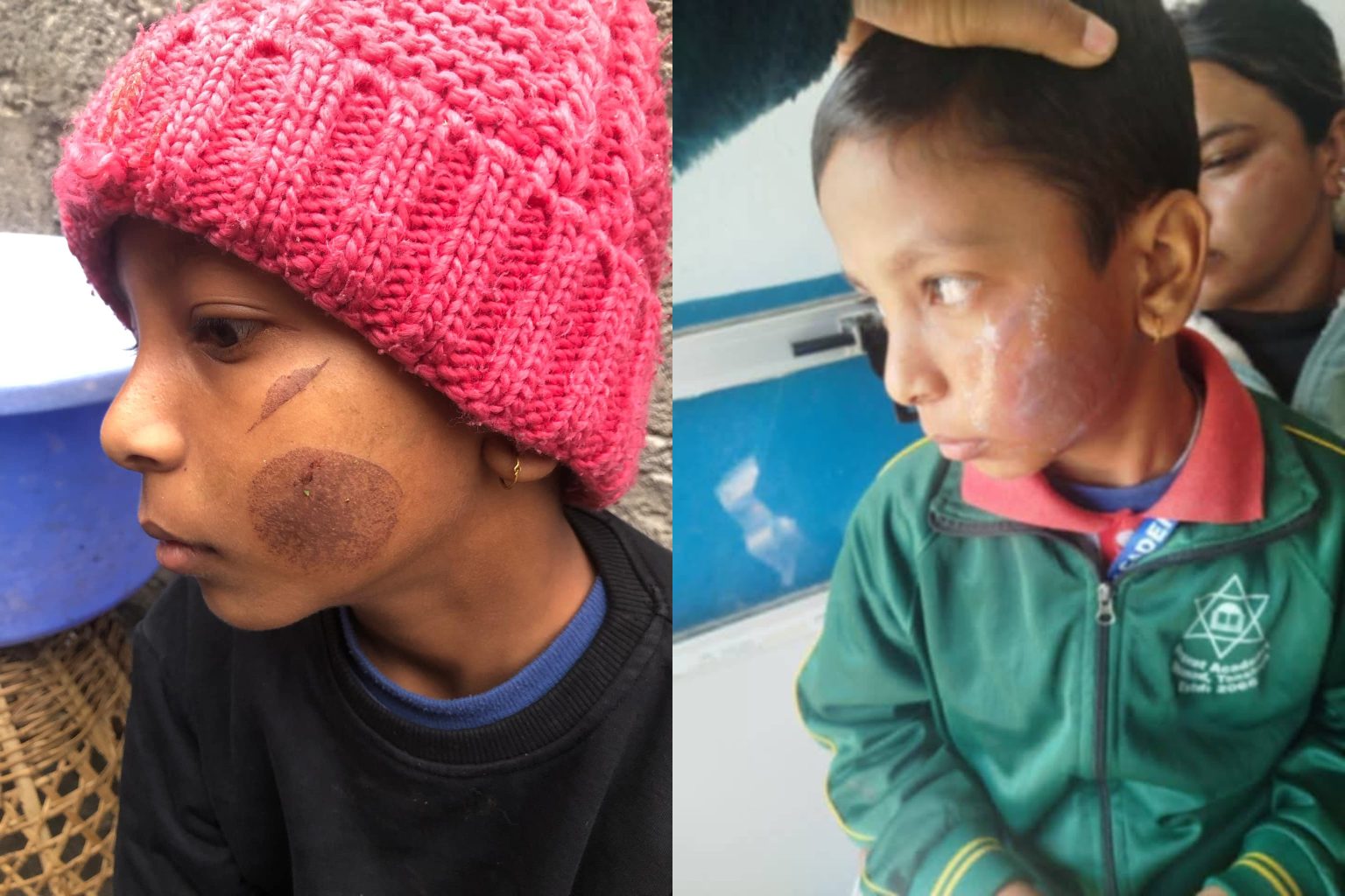 तनहुँमा शिक्षिकाले तातो पन्युले तीन विद्यार्थीको गाला डामिन्, पक्रियो प्रहरीले